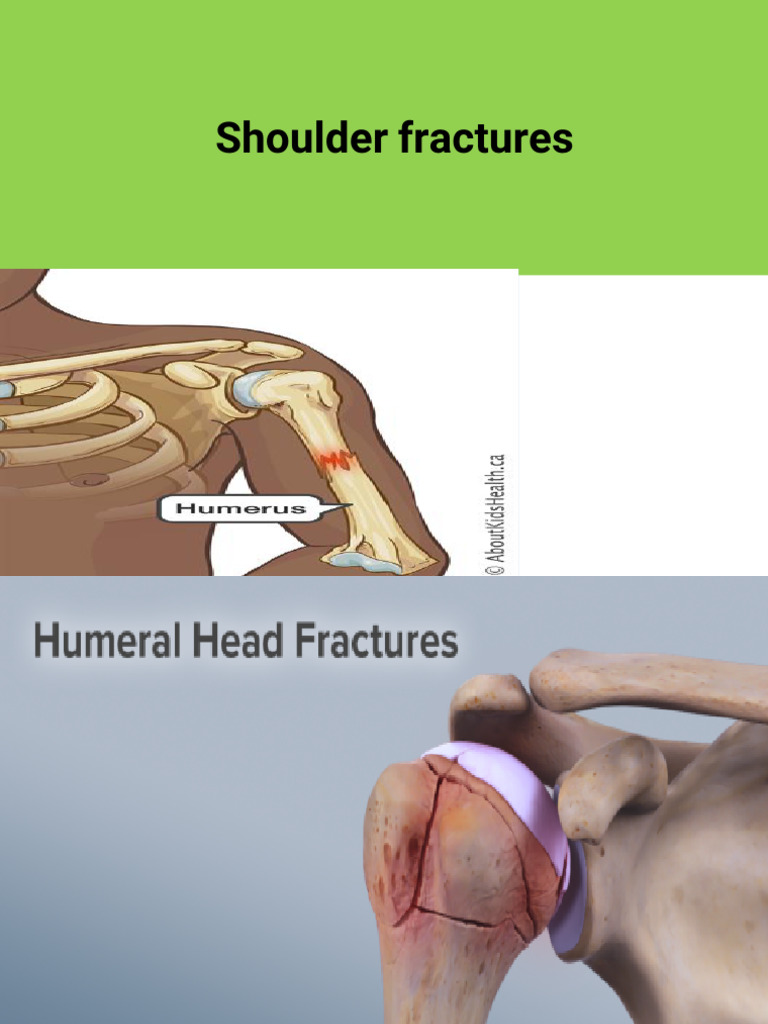 Shoulder Fractures(Distal Humer,Diapisis)Lecture 6.Pptm | PDF | Elbow ...