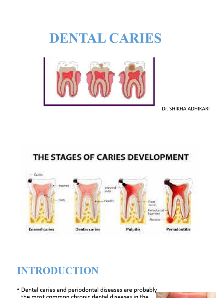 Understanding Dental Caries Causes & Prevention | PDF | Human Tooth ...