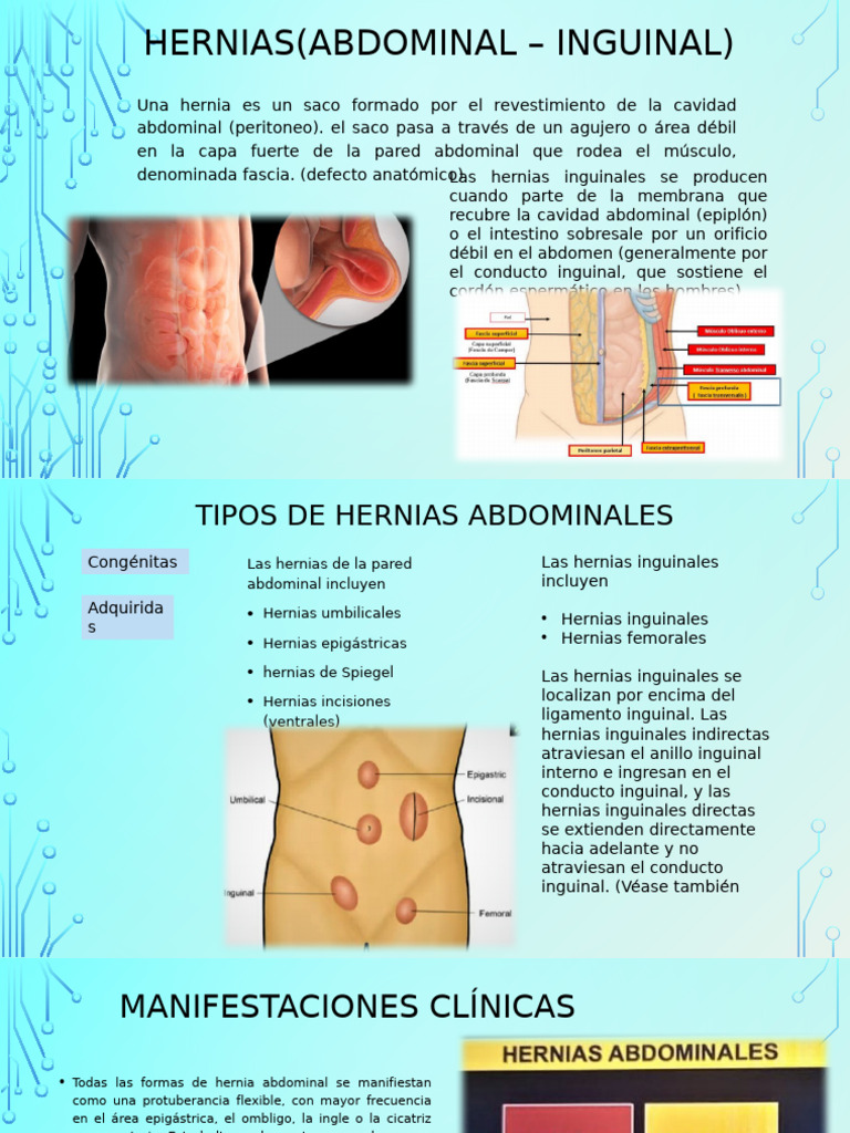 Hernias (Abdominal - Inguinal) | PDF
