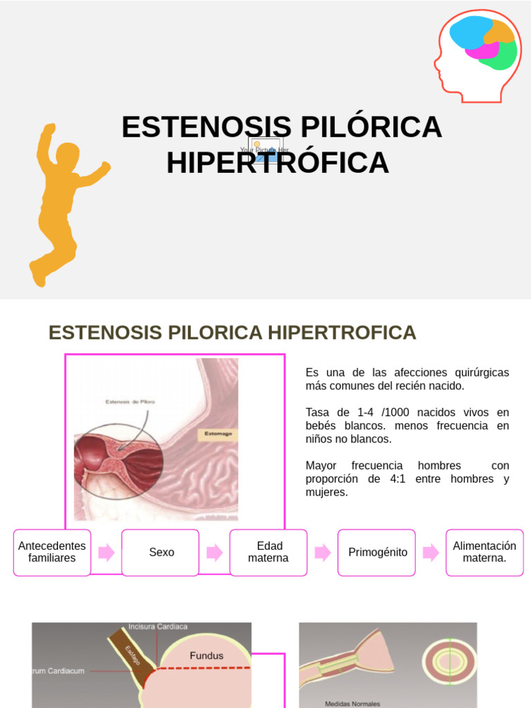 Estenosis Pilorica - Invaginacion | PDF