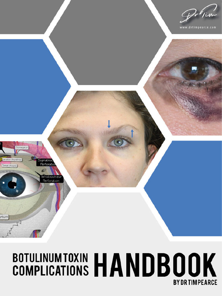 Botox Complications | PDF