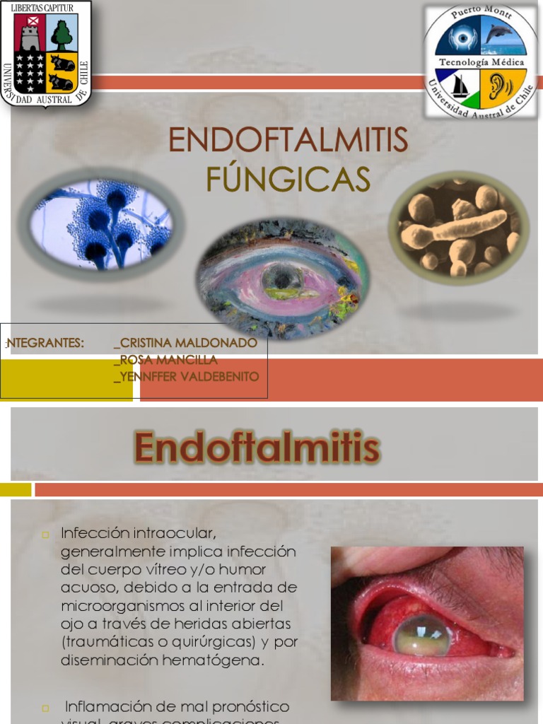 Endoftalmitis Fúngica: Causas y Tratamiento | PDF | Ojo humano | Hongo