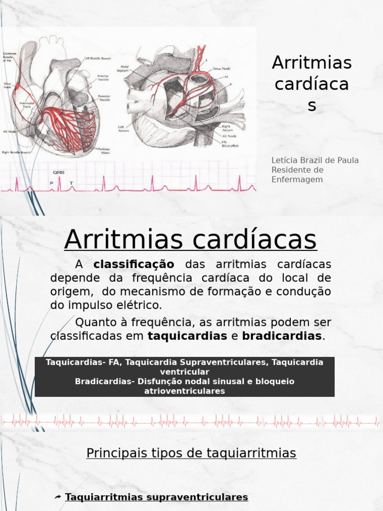 Arritmias Cardíacas | PDF