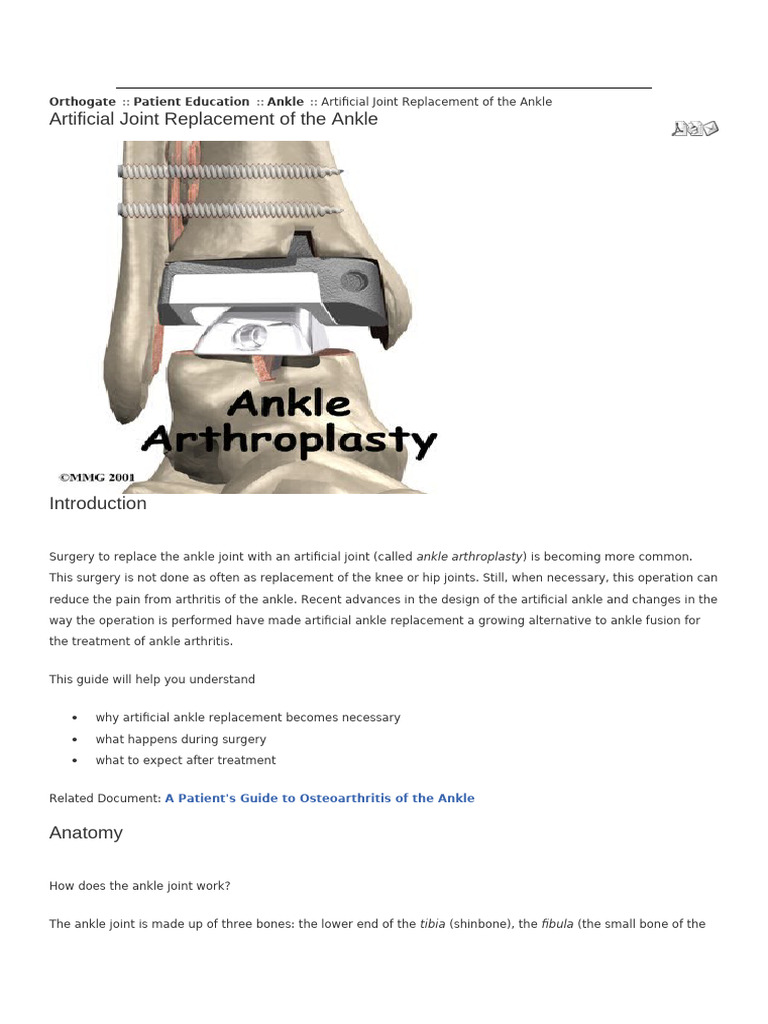 Ankle Replacement | PDF