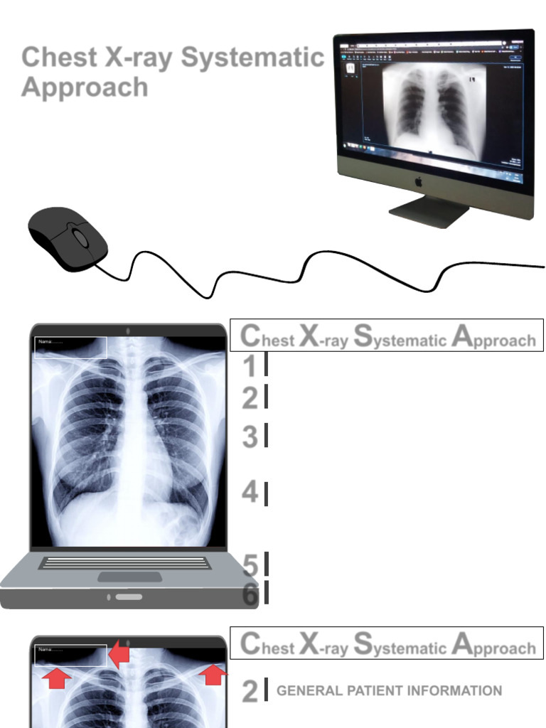 PPT Chest X-Ray Interpret | PDF