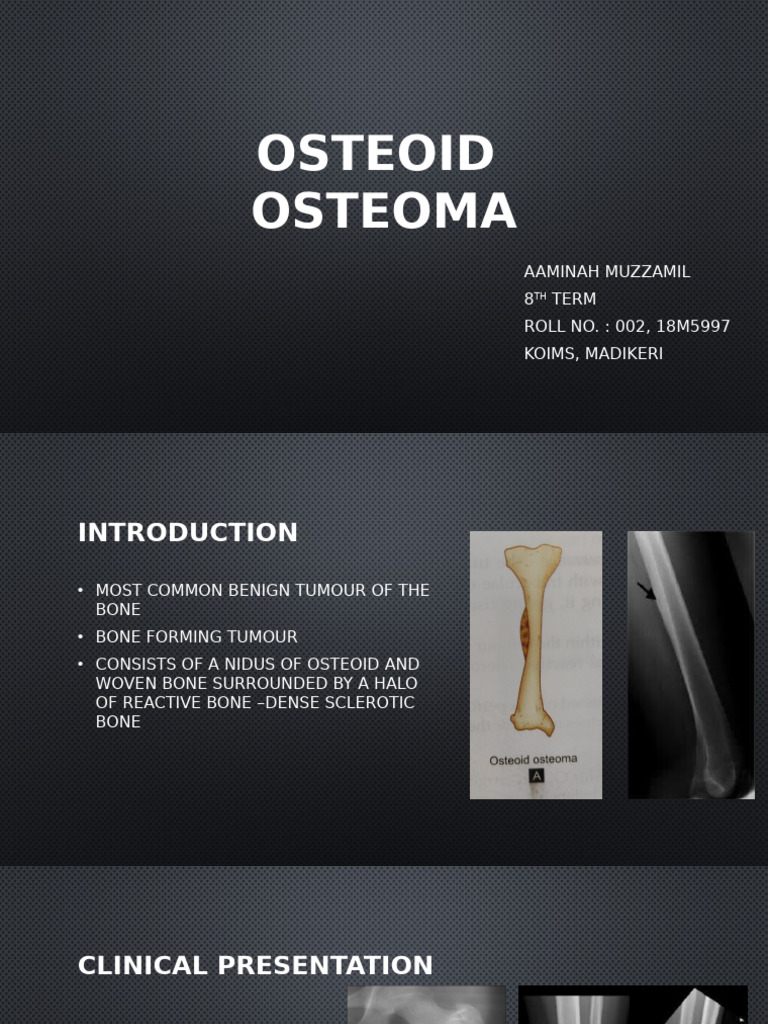 Osteoid Osteoma | PDF