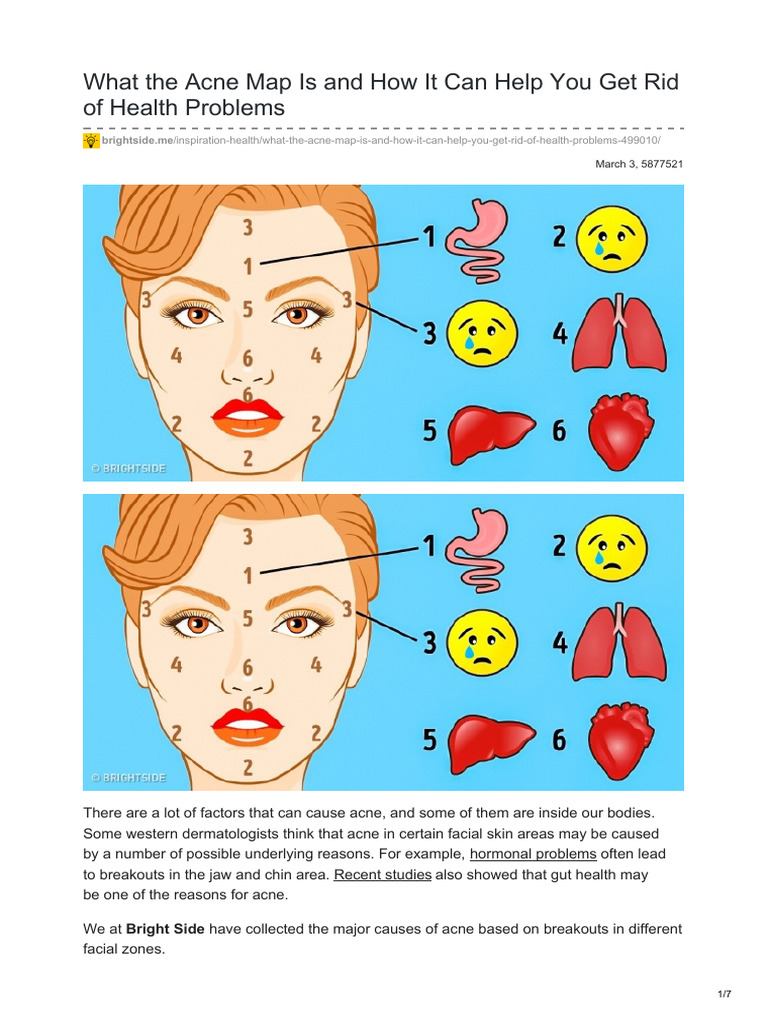 Brightside - Me-What The Acne Map Isand How ItCan Help You Get Rid ...