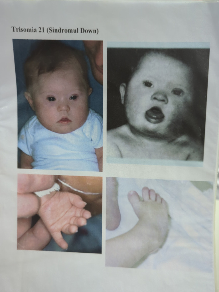 Genetics Syndromes | PDF
