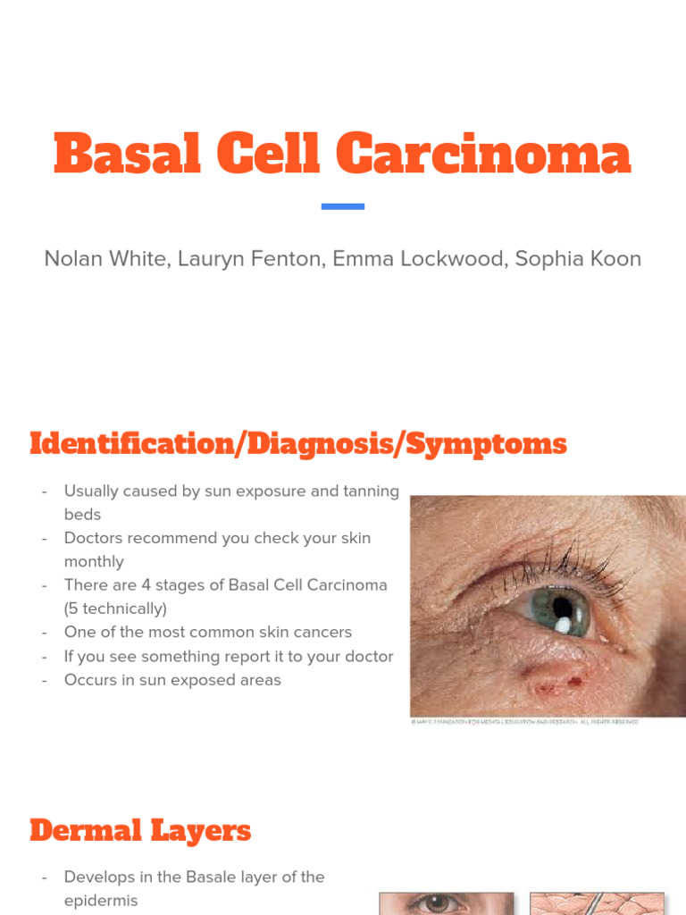 Basal Cell Carcinoma | PDF