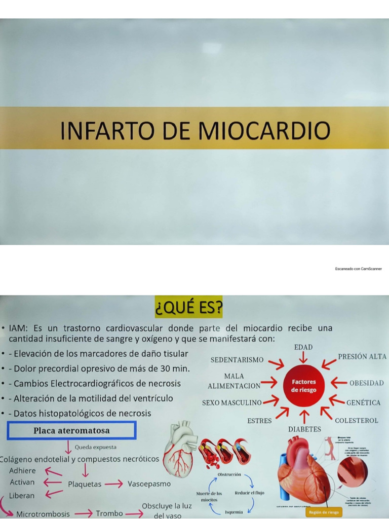 Infarto De miocardio | PDF