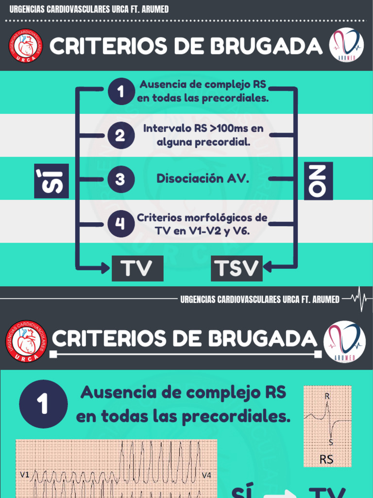 10criterios de Brugada | PDF