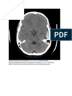 Epidural hematoma