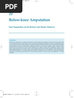 Download Below Knee Amputation by Johan harjono SN7676930 doc pdf