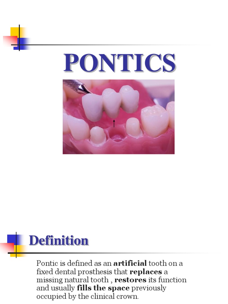 Pontics [Fixed Prosthodontics Seminar AmCoFam]