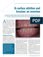 A-Attrition and Bruxism
