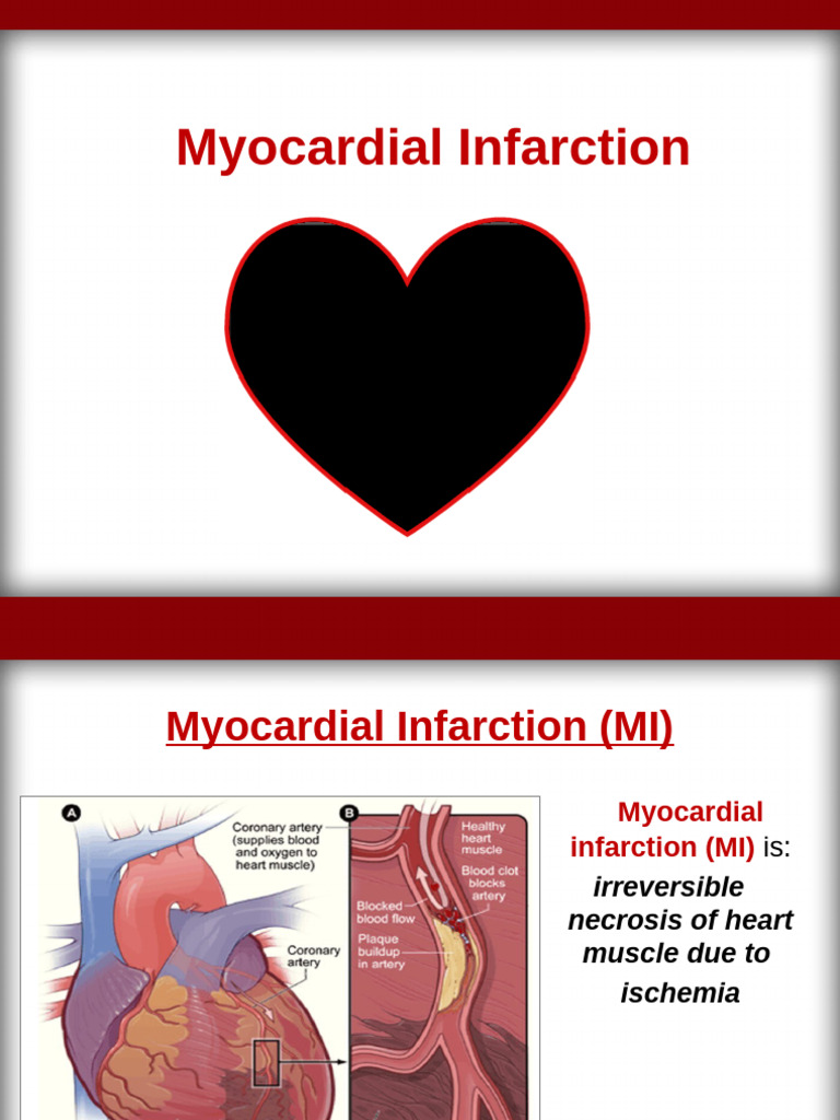 Lab 2 Myocardial Infarction | PDF