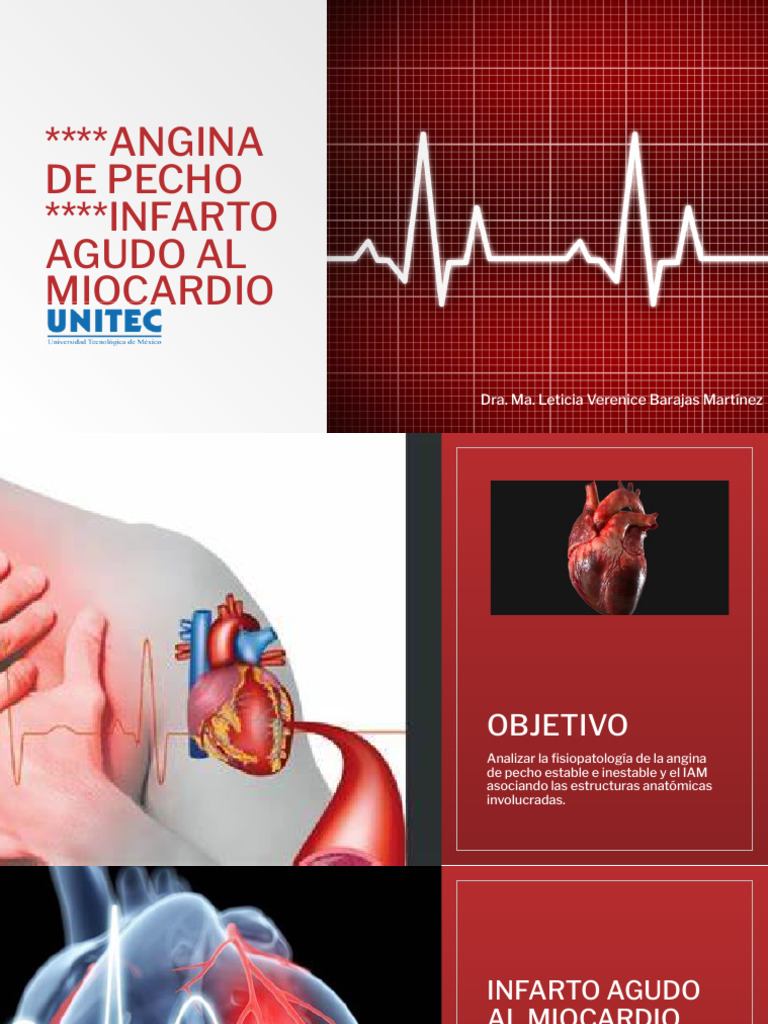 Angina de Pecho | PDF