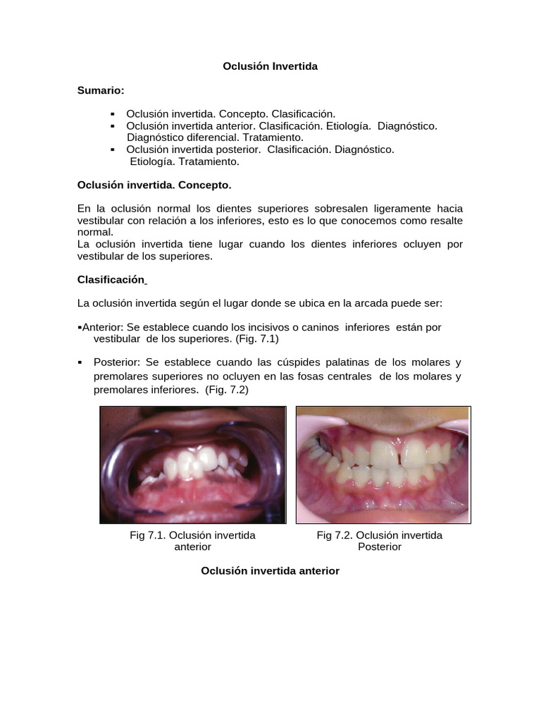 Oclusión Invertida Ok | PDF