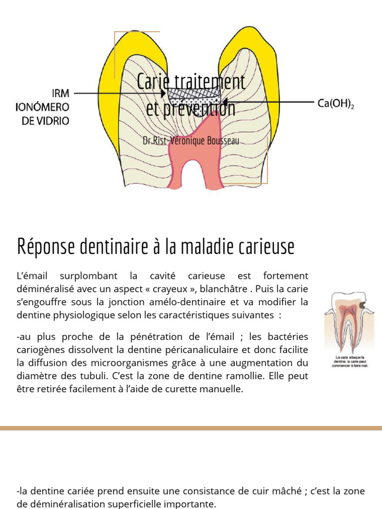 Carie Traitement Et Prévention | PDF
