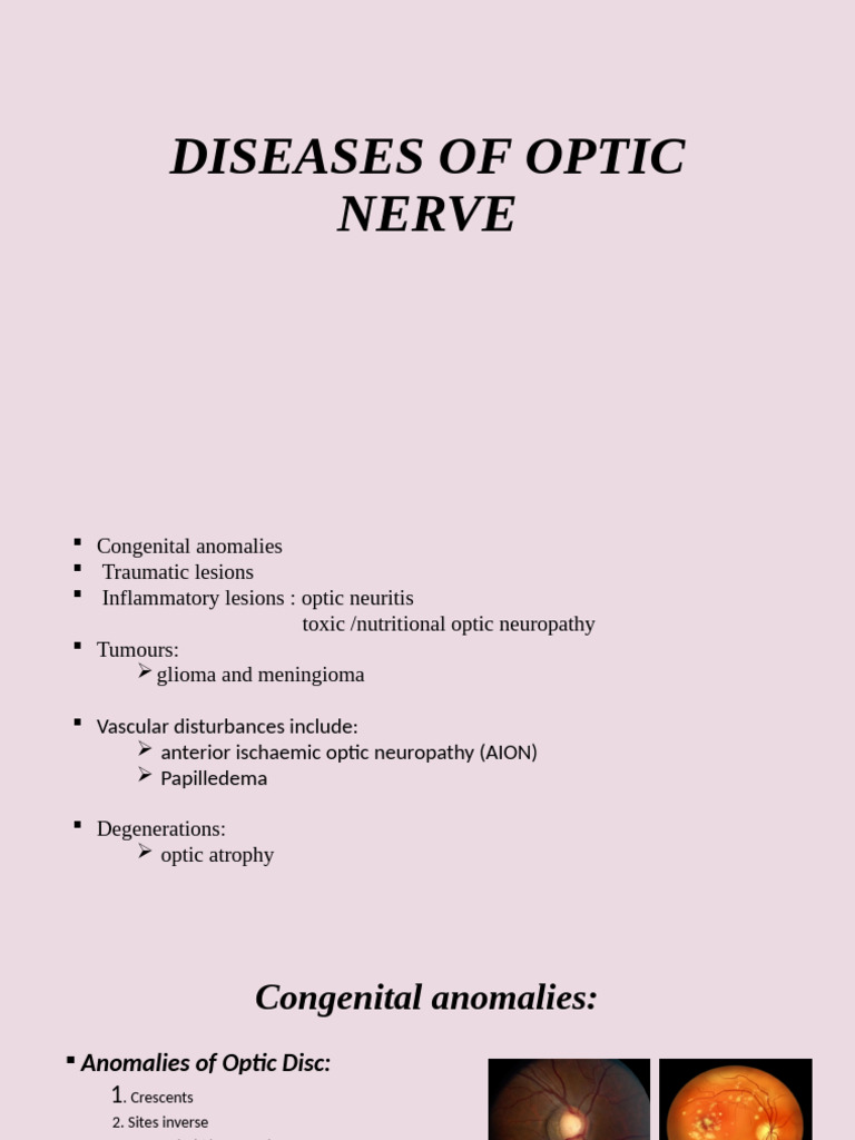 Diseases of Optic Nerve | PDF | Visual System | Wellness