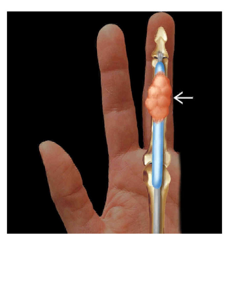 Giant Cell Tumor Tendon Sheath | PDF | Neoplasms | Causes Of Death