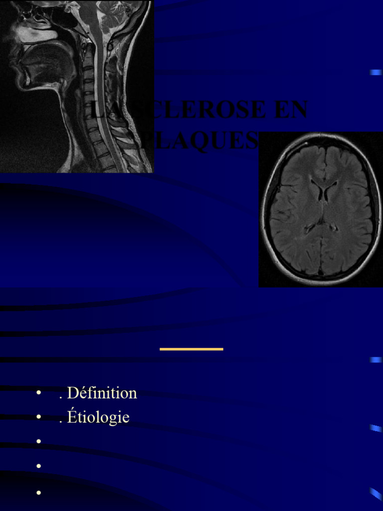 La Sclerose en Plaques (Sep) PDF — free download