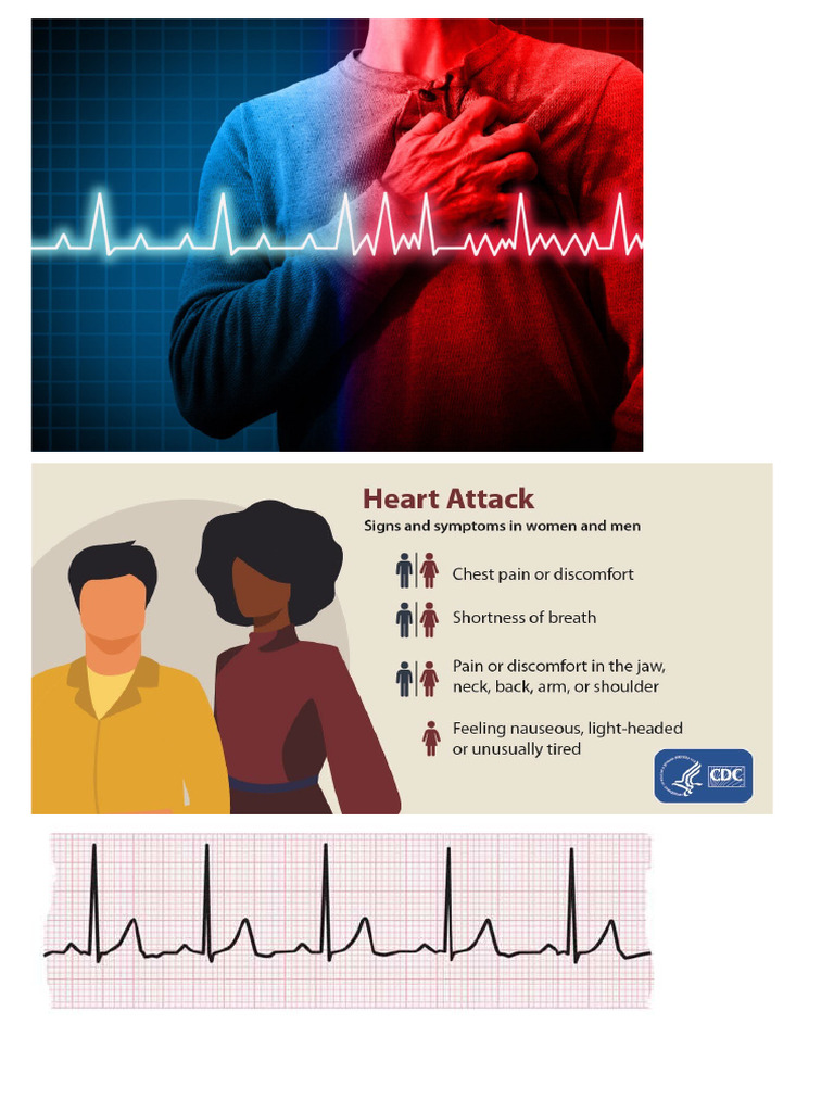 Complete Heart Blockage | PDF