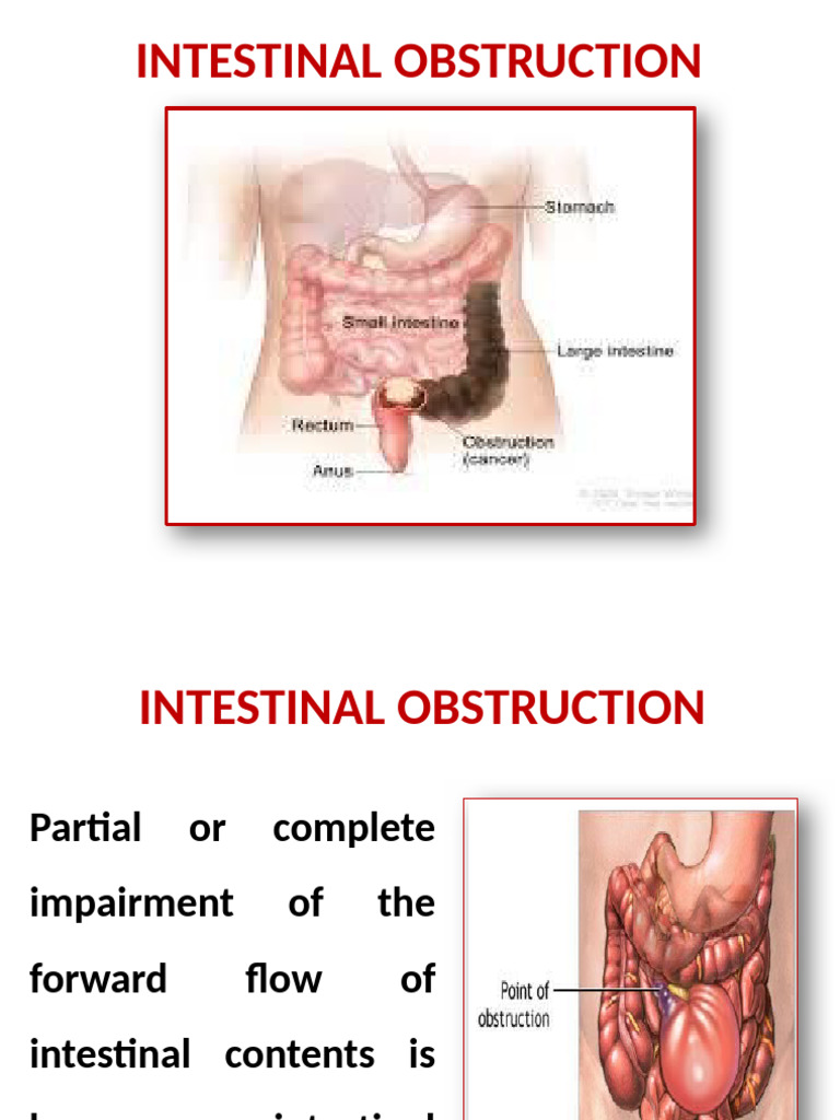 Intestinal Obstruction | PDF