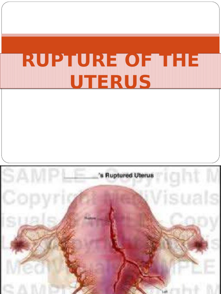 Rupture of The Uterus | PDF