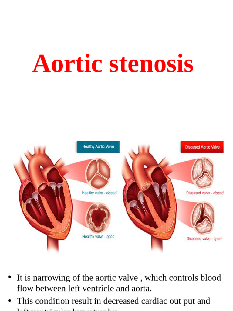 Aortic Stenosis | PDF