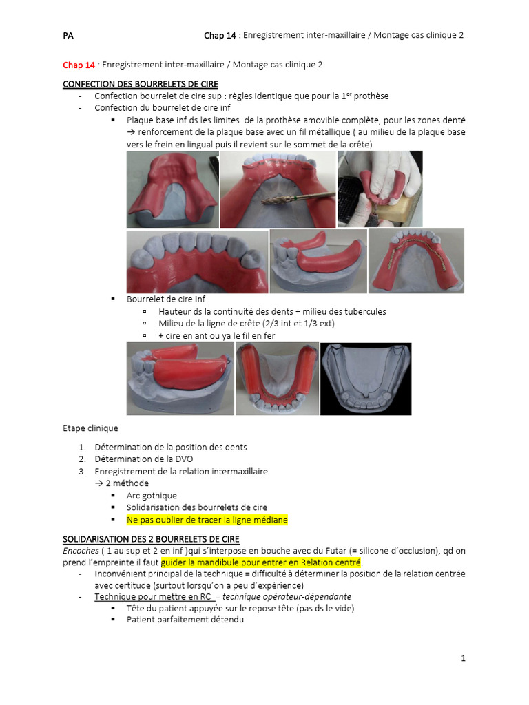 Chap 14, Enregistrement Inter-Maxillaire Et Montage Du Cas Clinique 2 | PDF