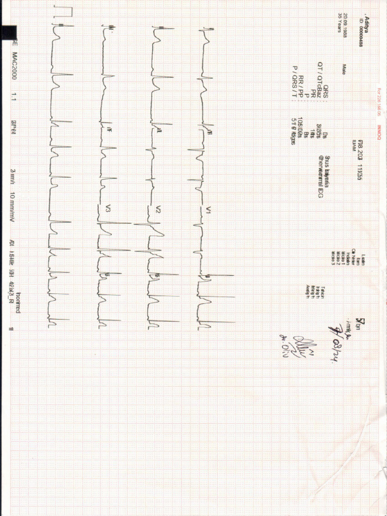EKG | PDF