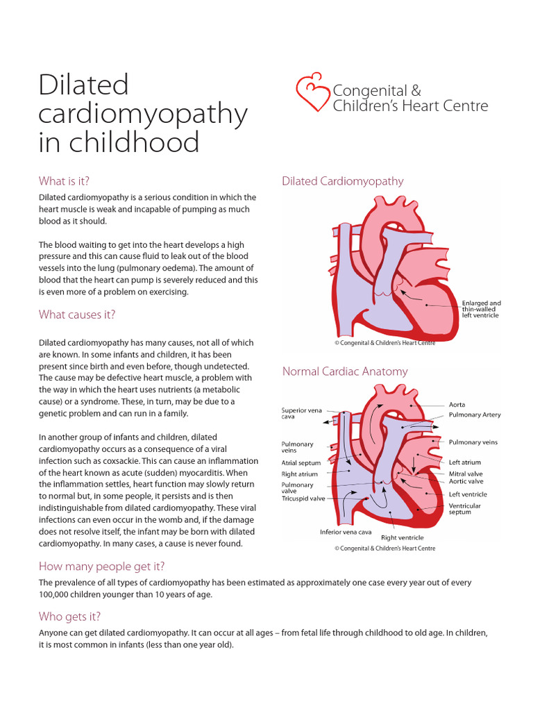 Dilated Cardiomyopathy in Childhood | PDF