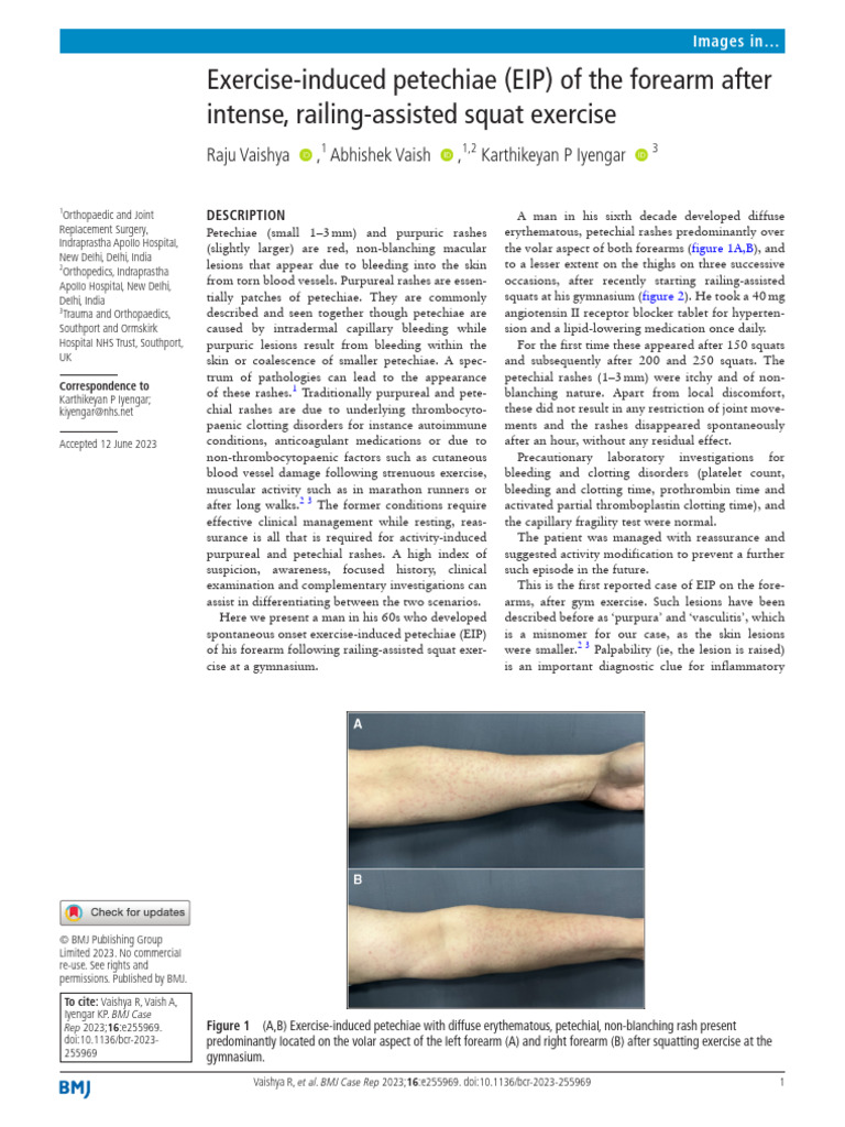 Exercise Induced Vasculitis 2 | PDF