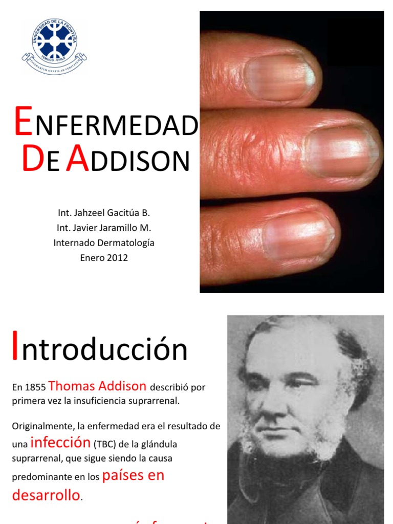 Enfermedad de Addison