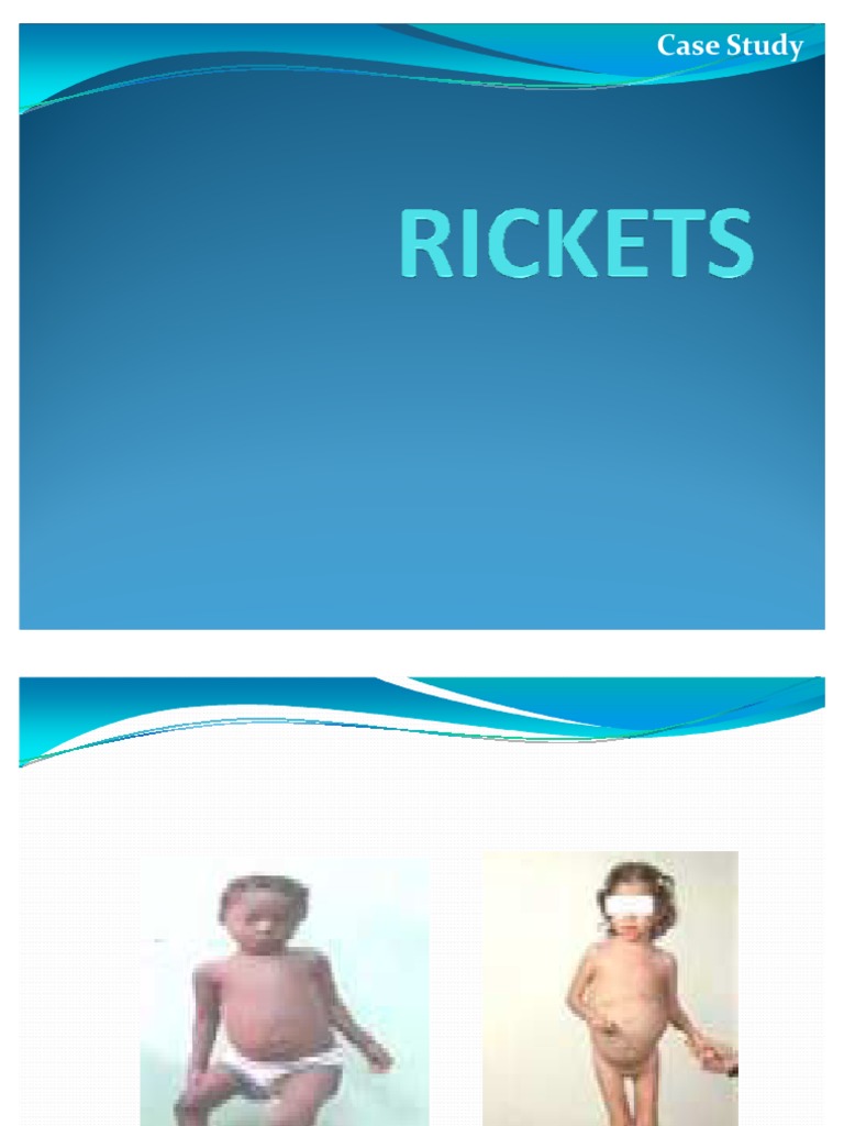 Ricket Disease Pdf 
