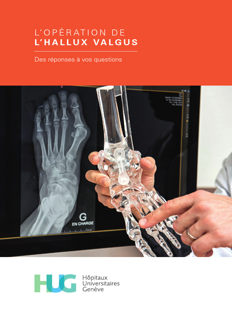 Hallux Vallgus | PDF