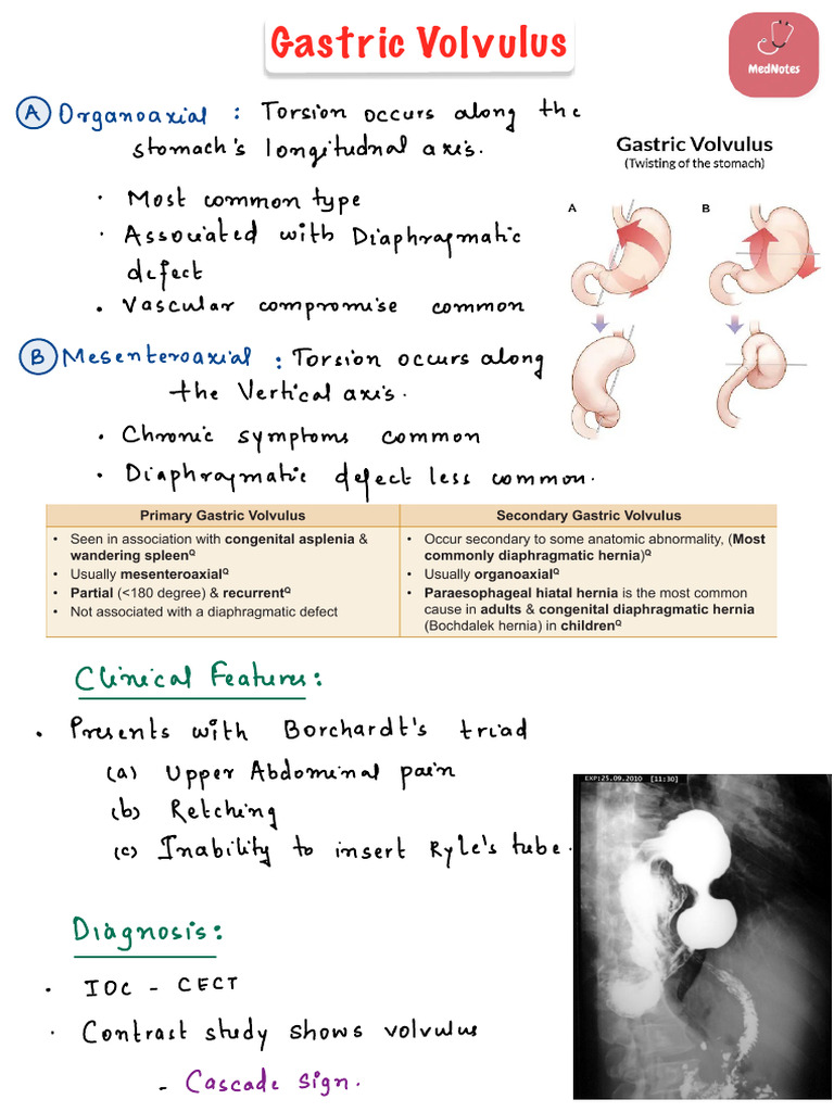 Gastric Volvulus | PDF