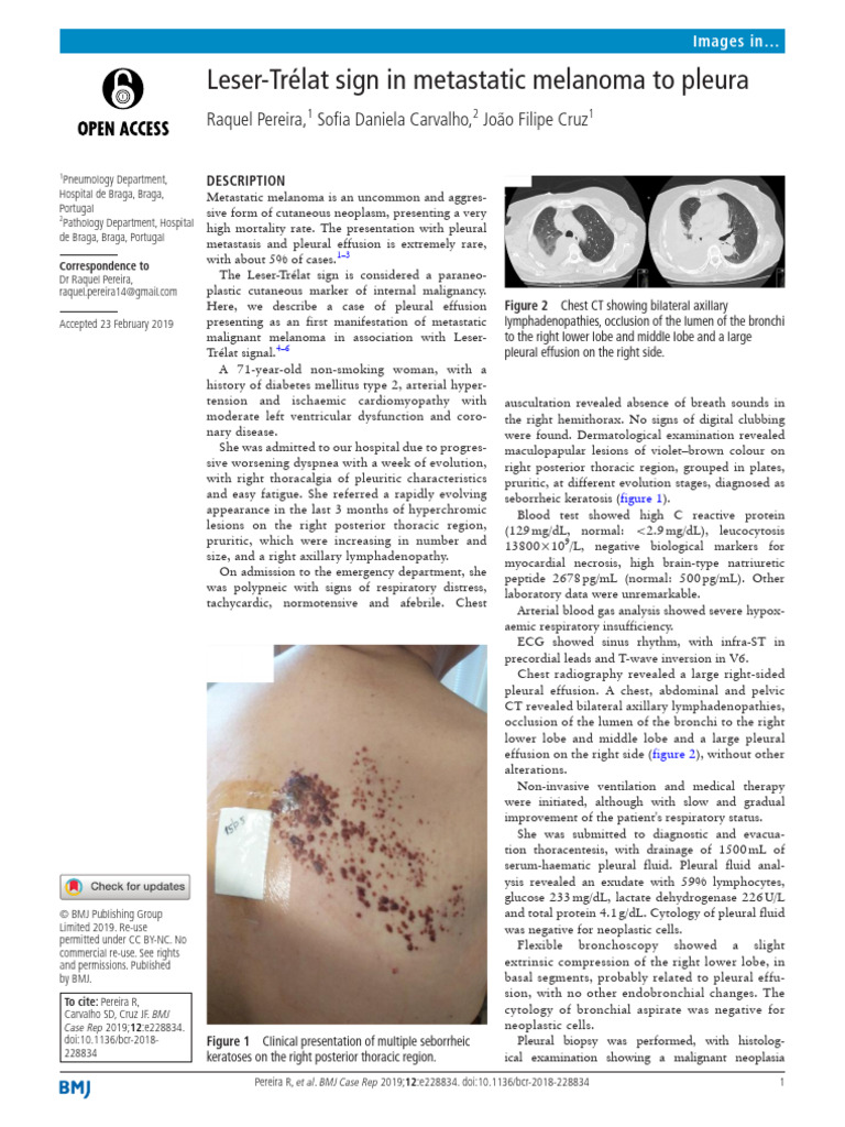Leser-Trelat Sign in Metastatic Melanoma To Pleura | PDF
