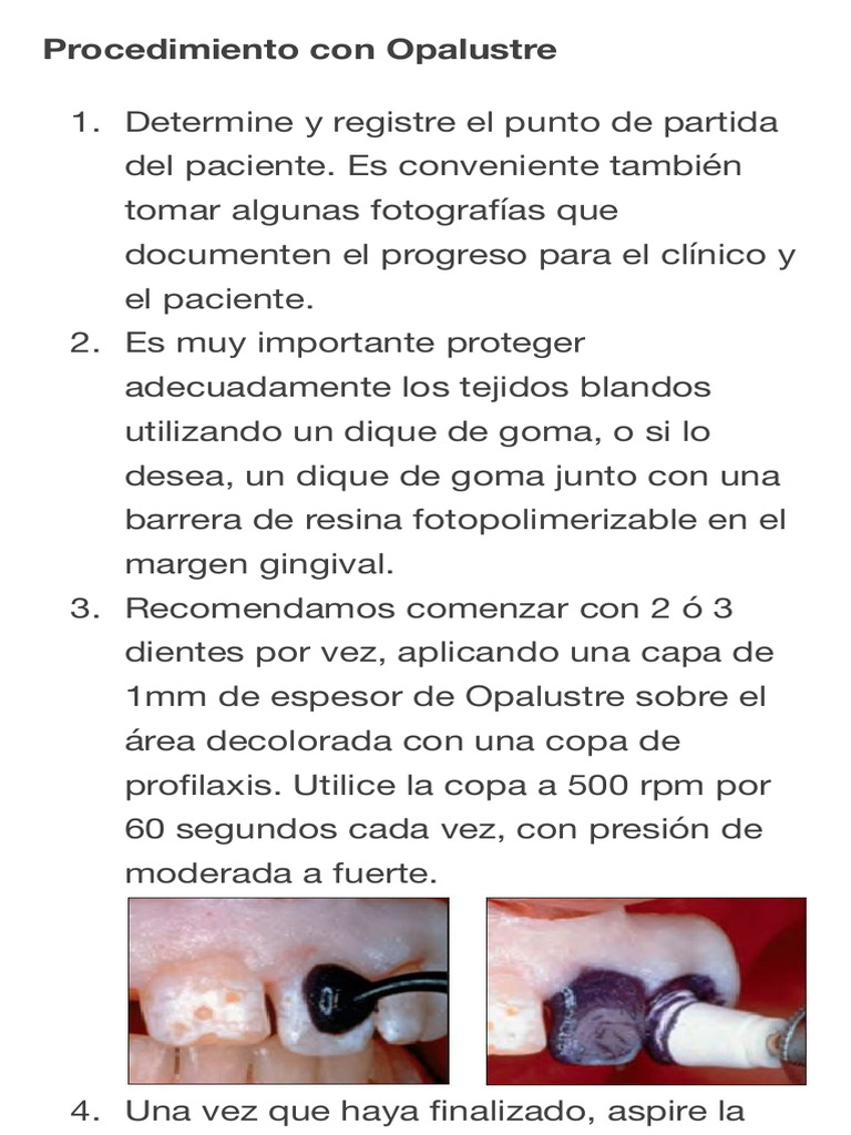 Microabrasión de Esmalte Técnica Paso a Paso 2 PDF