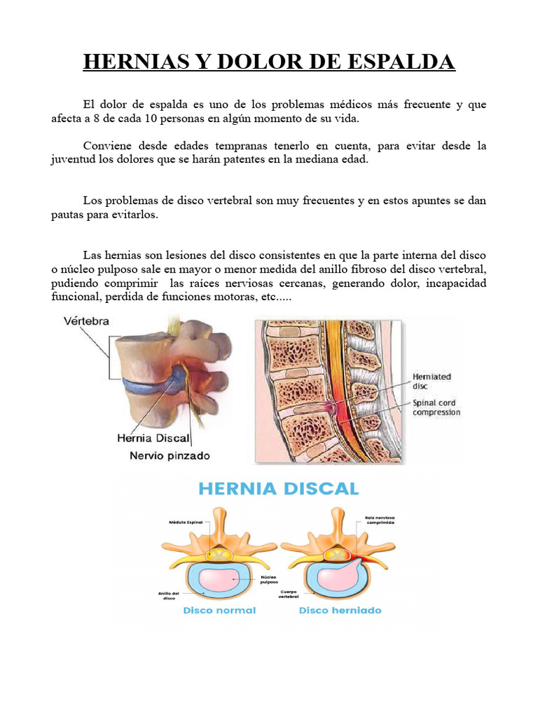 Hernias y Dolor de Espalda | PDF | Medicina CLINICA