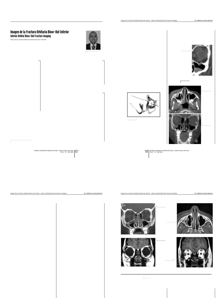 509455987-fractura-orbita-blow-out-pdf