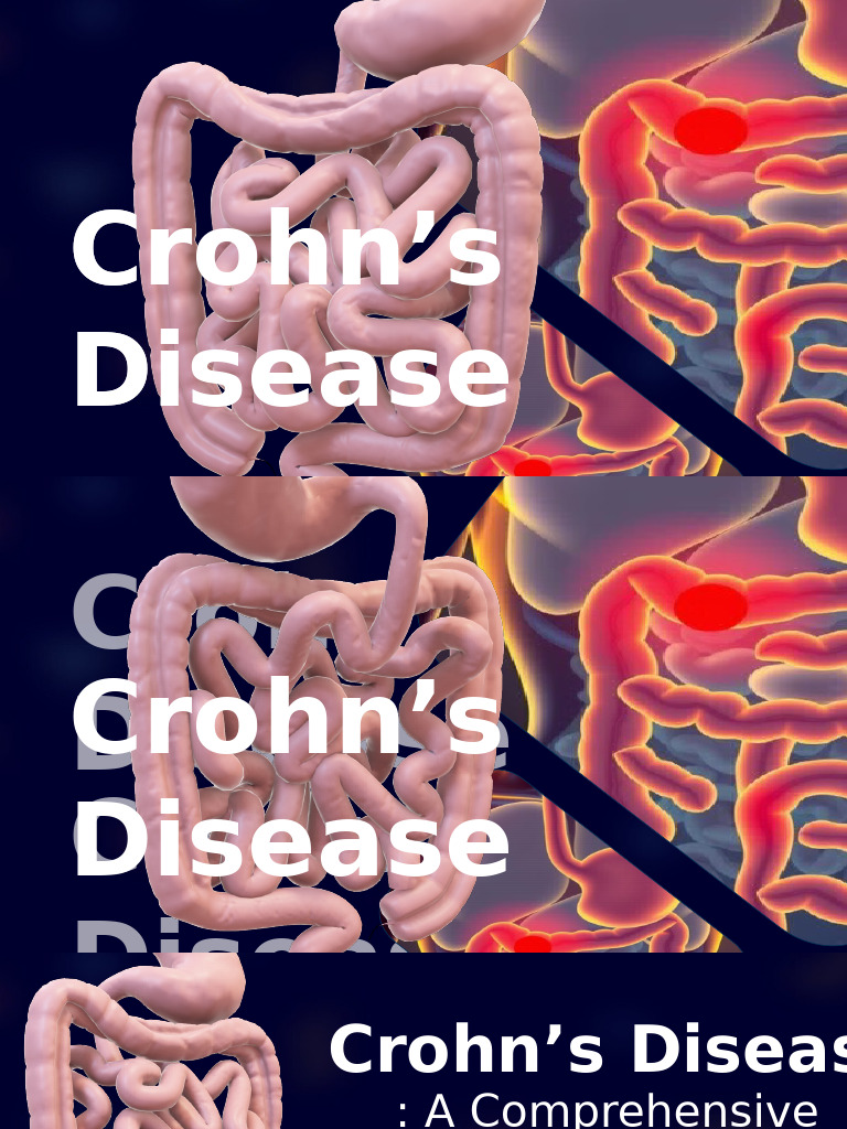 Crohns Disease A Comprehensive Overview PDF Crohn's Disease — free download