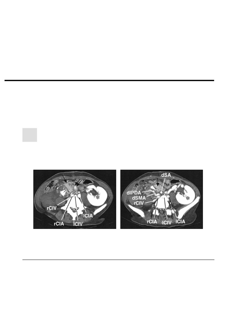 Freund Et Al 2012 Spectrum of Imaging Findings After Pancreas ...