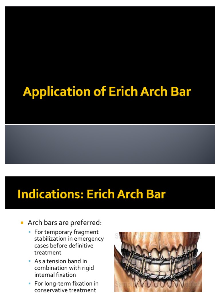 Application of Erich Arch Bar Tooth Mouth