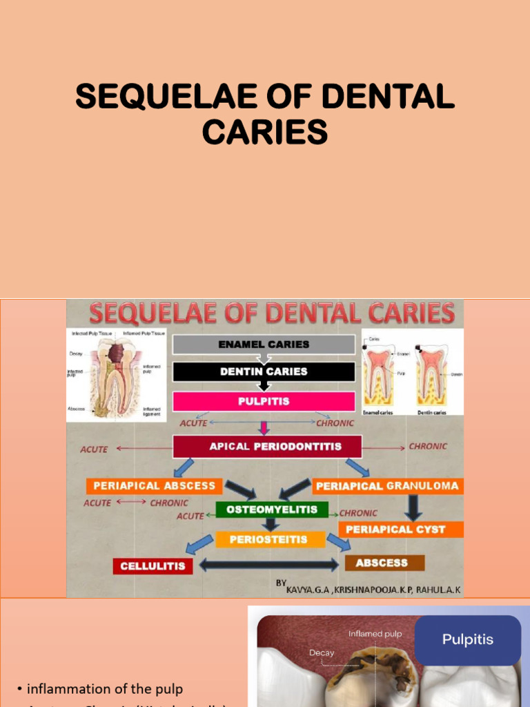 Dental Caries Sequelae and Pulpitis Types | PDF | Inflammation | Necrosis