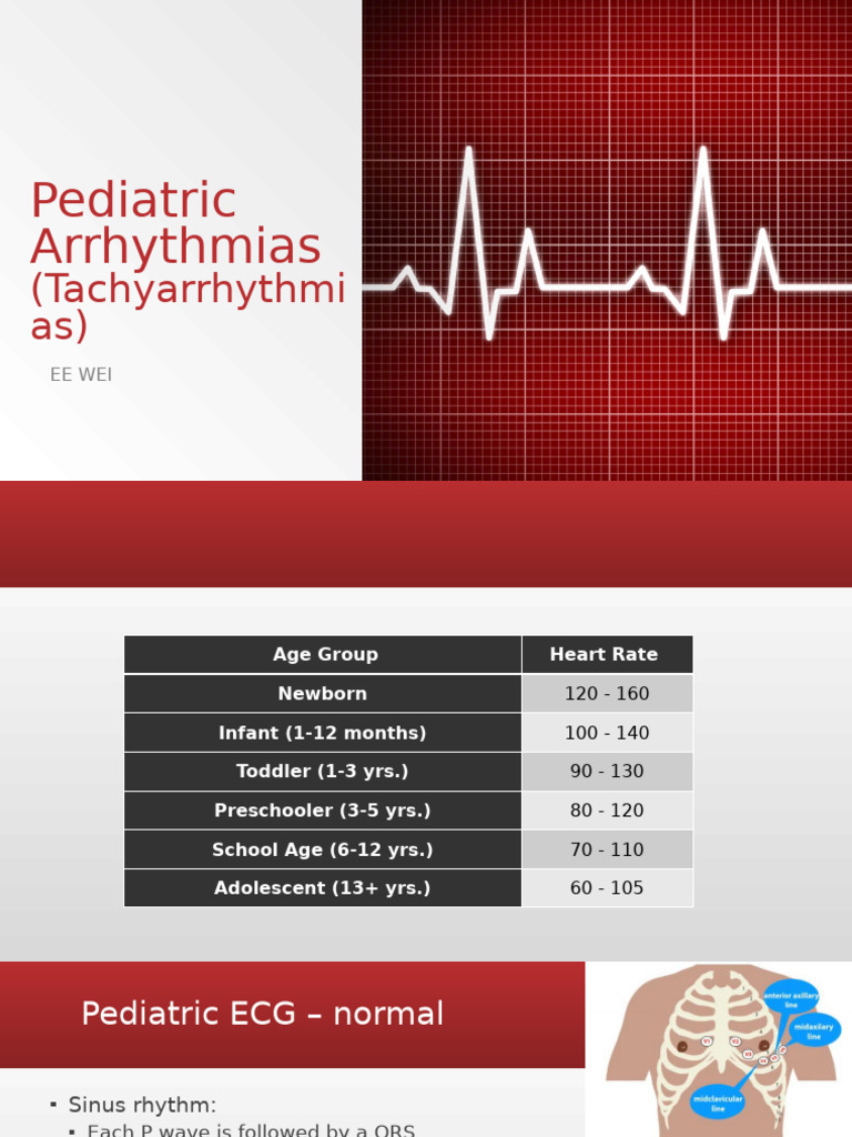 Pediatric Arrhythmias Overview | PDF | Diseases And Disorders | Heart