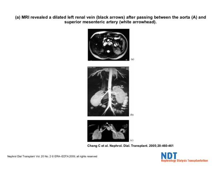 MRI. Nutcracker Syndrome PDF