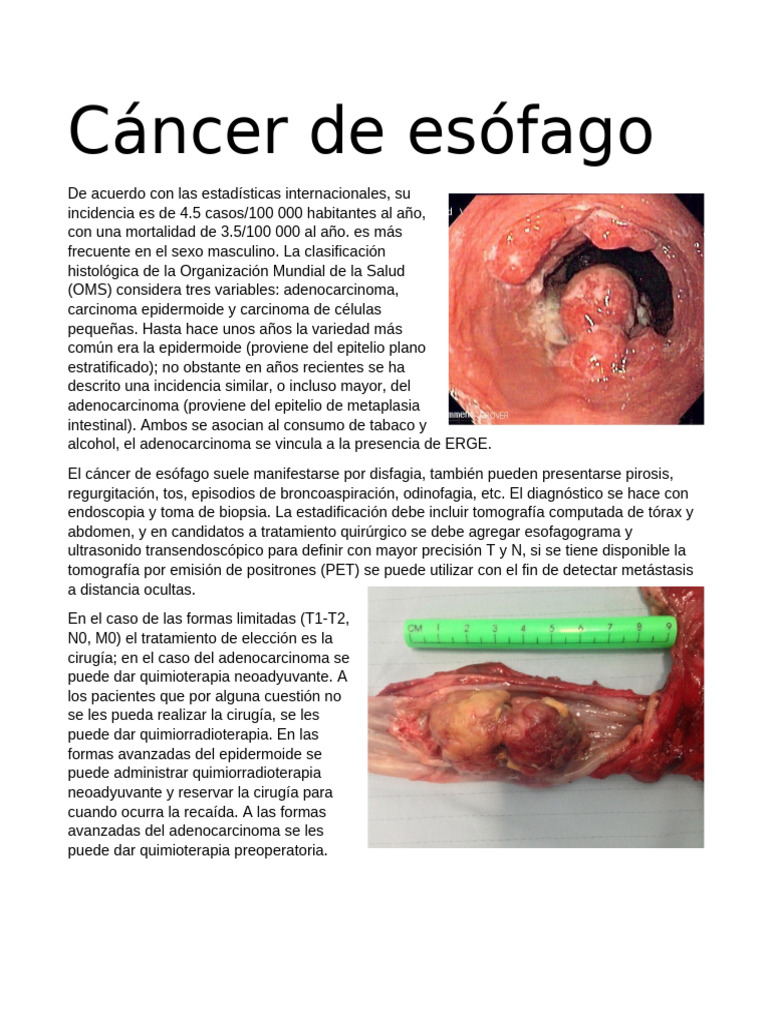 Cáncer de Esófago | PDF
