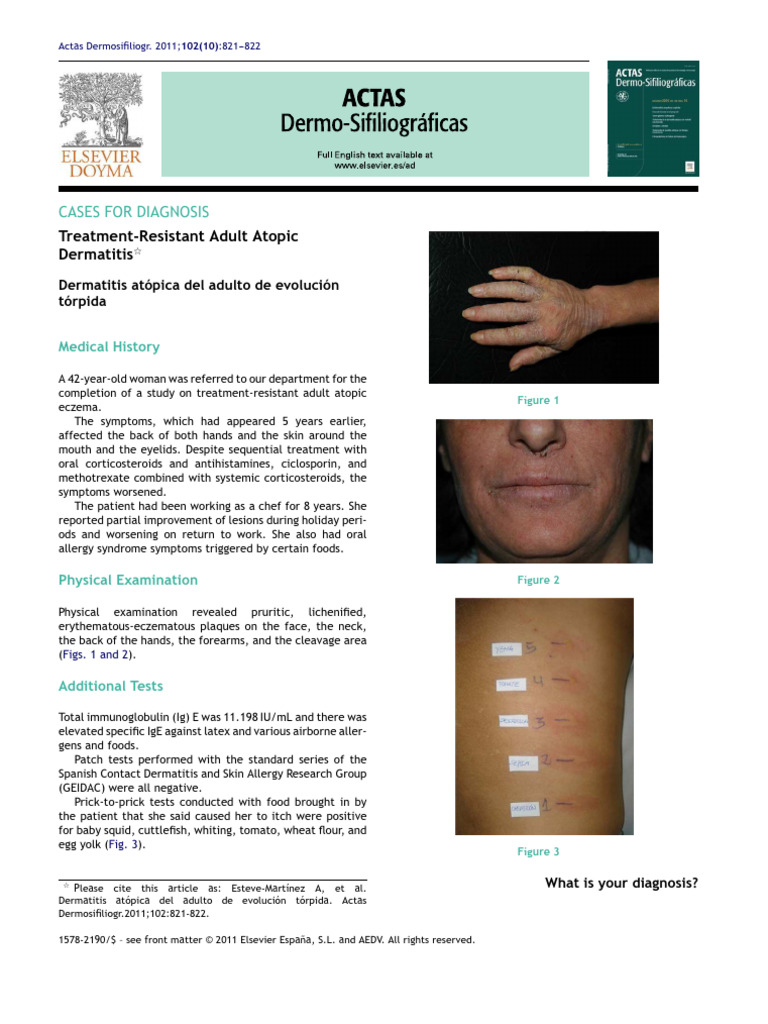 Treatment-Resistant Adult Atopic Dermatitis | PDF | Dermatitis | Allergy